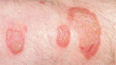 It's caused by a yeast infection. . Blisters on groin area male